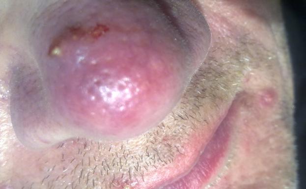 Imagenes de la enfermedad rosacea